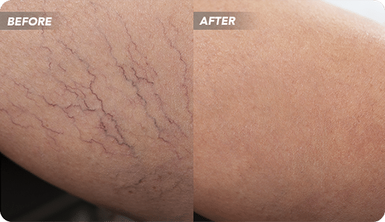 VTCBefore-After-12