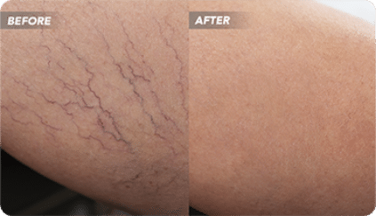 How Can I Find the Best Vein Clinic Near Me in Clifton?