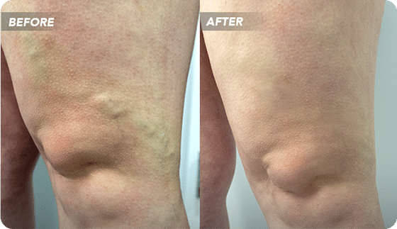 VTCBefore-After-3