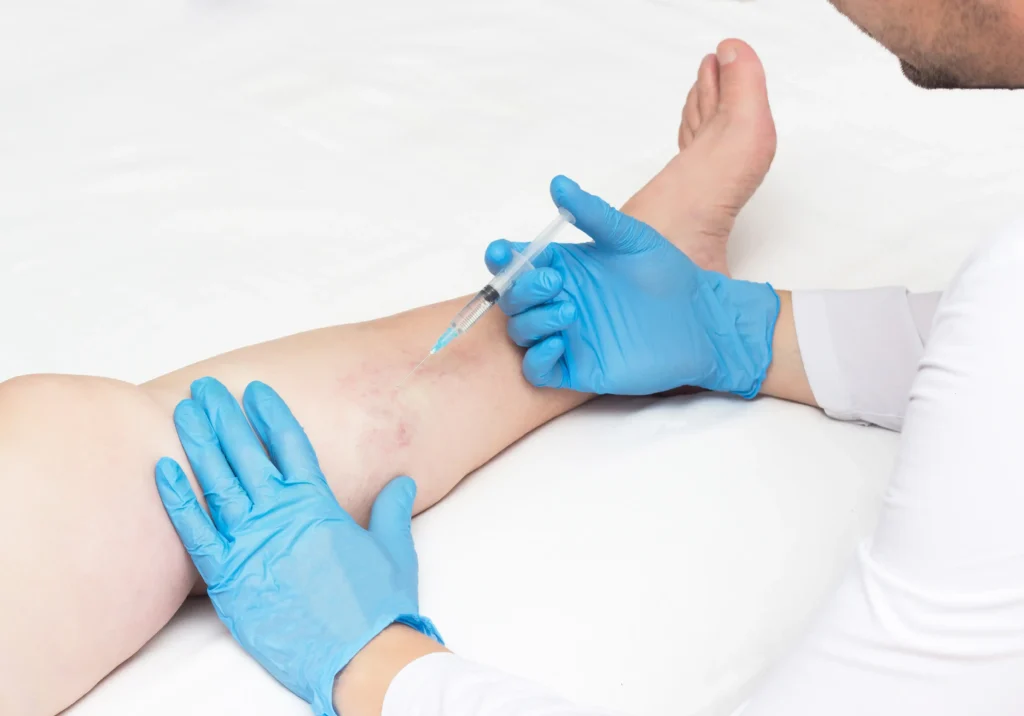 Top Clinics for Spider Vein Treatment in Clifton, NJ and Surrounding Areas